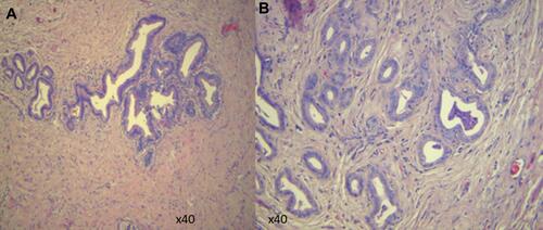 Figure 1 Mucosa consisting of variably sized glands lined by cytologically bland epithelium (A) and proliferated bland glands, with mild chronic inflammatory infiltrates (B).