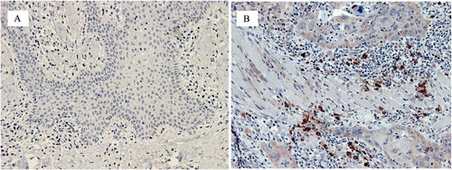 Figure 4. Photomicrographs showing the expression of TLR2 in the stroma of inflammatory hyperplasia. A, and OSCC B. Expression of TLR2 was significantly more in OSCC tissues in comparison to control group (inflamed mucosa). IHC staining was used to stained TLR2 positive cells using TLR2 antibody and DAB chromogen.