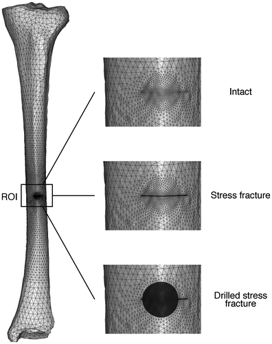 Figure 1. Geometries for the computational models. Overview of the intact tibia (left), and magnifications of the intact (top), stress fractured (middle), and drilled (bottom) tibia. Light gray elements are cortical bone, whereas dark gray elements are granulation tissue.