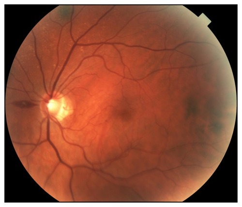 Figure 2 Fundus examination OS at presentation showing one Roth spot with slight retinal nerve fiber layer swelling at the optic disc margin superiorly and inferiorly, but much less venous distention than OD.