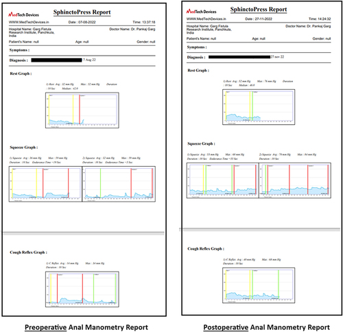 Figure 2 The graph of preoperative and postoperative anal manometry in a 25-year-old female patient who underwent fistulotomy for rectovaginal fistula with no rectovaginal septum involvement (RVF-II) fistula.