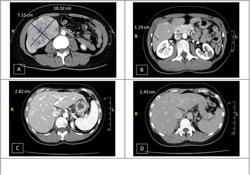 Figure 2 Imaging studies before and after ICI therapy. (A) A 10.32×7.15 cm hypervascular tumor was found at S6 of liver. (B and C) Recurrent HCCs were found at S6 (1.29 cm) (B) and S1 (2.82 cm) (C) of liver. (D) The tumor at S1 demonstrated partial response after 8 cycles (from 2.82 cm to 1.94 cm). However, it enlarged at cycle 13 (from 1.94 cm to 2.43 cm).
