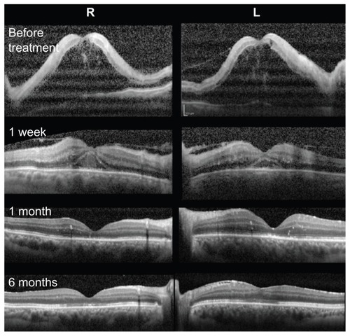 Figure 2 Changes in spectral-domain optical coherence tomograms at onset, and at one week, one month, and 6 months after treatment.