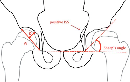Figure 1. Drawing of an anteroposterior view of the pelvis showing left hip with Perthes’ disease and the right hip unaffected. Sharp’s angle is illustrated on the left hip. The prominence of the ischial spine on the left side is a positive ischial spine sign (ISS). On the right unaffected hip, W shows acetabular width and D shows acetabular depth. Acetabular depth-width ratio is defined as (depth/width) × 1,000.
