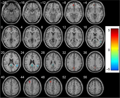Figure 1 Abnormal resting-state FC in the DMN in schizophrenia patients at baseline.