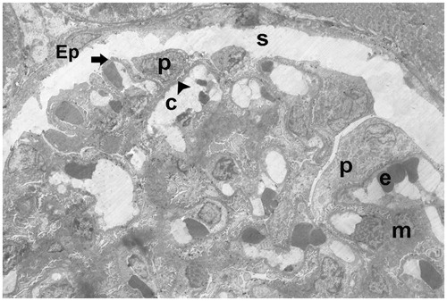Figure 20. (Electron micrographs show ischemia–reperfusion + aliskiren 100 mg/kg group ultrastructure). Electron micrographs showing glomerular capillary (c) with normal basal lamina (arrow head). Electron microscopic findings show typical podocytes (p) and foot processes (arrow). Mesangial cell (m). Erythrocyte (e). Typical parietal epitalial cell (Ep). 10,000×.