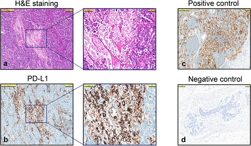 Figure 2 PD-L1 staining scored with CPS. Representative CPS score (CPS 80) of the same area in a TNBC tumor, (a) H&E staining 500 µm and 100 µm in inlet, (b) PD-L1 staining 500 µm and 100 µm in inlet, (c) Tonsil tissue PD-L1 positive control, (d) Normal breast tissue PD-L1 negative control.