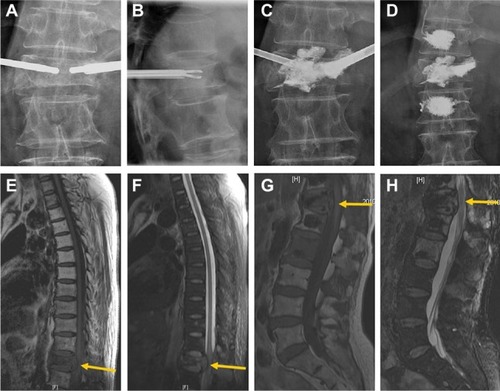 Figure 1 Group A Spinal metastatic tumor with epidural involvement of T12 vertebra owing to metastasis from lung cancer in a 67-year-old female patient with spinal pain prior to the procedure.