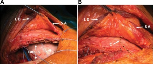 Figure 1 Right posterolateral thoracotomy (A) and SAP block (B): a 19-gauge catheter is tunnelized subcutaneously and its tip positioned in the plane below the serratus muscle and the rib cage.