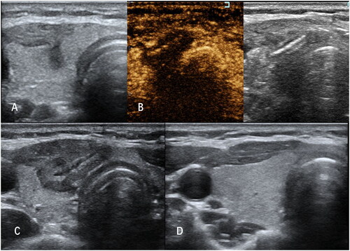 Figure 3. A case of MWA. (A) A 37-year-old female patient with a suspected lesion located in the right lobe of the thyroid, which was confirmed as PTMCs by FNAB; (B) After US-guided MWA, the ablated lesion was evaluated with CEUS; (C) In the first week follow up, the ablated lesion appeared as a well-defined heterogeneous echogenic area on the grayscale US with a central hypoechoic ablated needle channel; (D) On the final follow-up, the ablated area was almost completely absorbed.