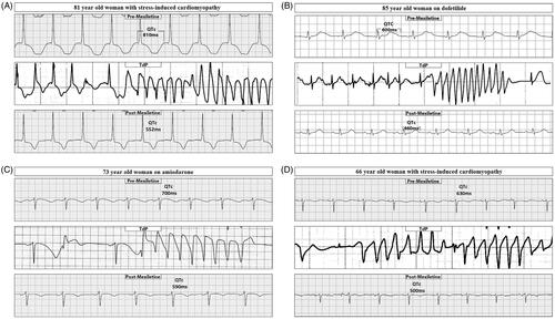 Figure 1. Electrocardiogram (ECG) strips of four patients with long QT premexiletine, followed by torsade de pointes (TdP) and postmexiletine ECG strips. In patient A, the postmexiletine ECG was recorded 24 h after the first dose and after a total administration of 400 mg. In patient B, the post-mexiletine ECG was recorded 15 h after the first dose and after a total administration of 300 mg. In patient C, the postmexiletine ECG was recorded 25 h after the first dose and after a total administration of 600 mg of mexiletine. In patient D, the postmexiletine ECG was recorded 23 h after the first dose and after a total administration of 600 mg. Note that all four episodes of TdP occurred following a long-short interval. (With permission from Xiaolin Xue [Citation109]).