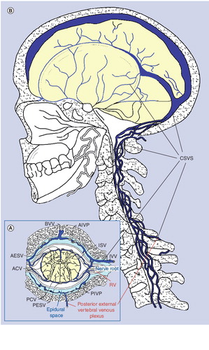 Figure 1. The cerebrospinal venous system.(A) The spinal portion of the cerebrospinal venous system, including the vertebral venous plexuses, the epidural space and their relationship to the spinal cord and the nerve roots. Horizontal section through the spine. (B) The anatomic continuity of the spinal and cerebral venous plexuses. ACV: Anterior central vein; AESV: Anterior external spinal vein; AIVP: Anterior internal vertebral plexus; BVV: Basivertebral vein; CSVS: Cerebrospinal venous system; ISV: Internal spinal vein; IVV: Internal vertebral vein; PCV: Posterior central vein; PESV: Posterior external spinal vein; PIVP: Posterior internal vertebral plexus; RV: Radicular vein.(A) Adapted from Citation[163]