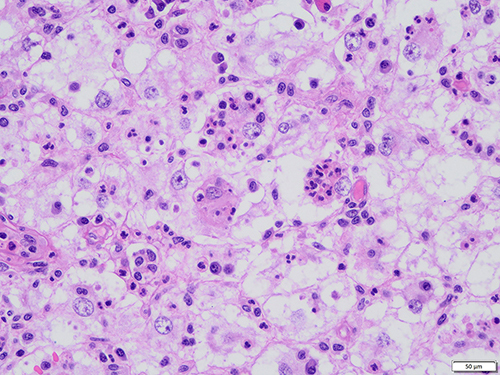 Figure 3 The phenomenon of phagocytic lymphocytes, plasma cells, and neutrophils in the cytoplasm (HE).