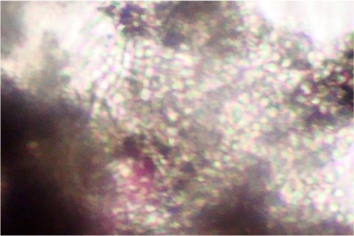 Figure 1 Endothrix pattern of hair invasion, with multiple spores present within the hair shaft (“bag of marbles” appearance) (potassium hydroxide 10% mount; Magnification × 400).