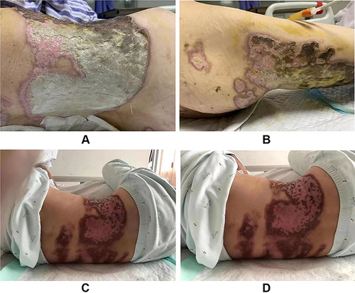 Figure 3 Wound situation of the patient before and after treatment. (A) Skin wound of the lower back; (B) skin wound of the right thigh; (C and D) Skin wound of the lower back after 2-months’ treatment.