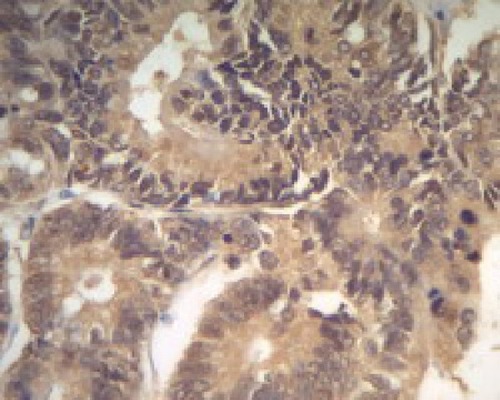 Figure 2 Positive expression of Piwil2 in colon cancer, ×400.