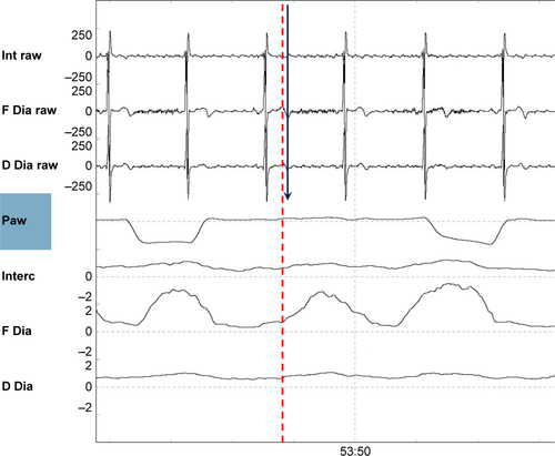 Figure S4 An ineffective effort.Notes: Shown are (from top to bottom) the raw intercostal signal (Int raw), the raw frontal diaphragm signal (F Dia raw), the raw dorsal diaphragm signal (D Dia raw), the pressure wave (Paw), the average intercostal signal (Interc), the average frontal diaphragm (F Dia) signal, and the average dorsal diaphragm signal (D Dia). An electromyography signal (dotted red line) was not followed by a breath delivered by the ventilator (straight arrow blue line).