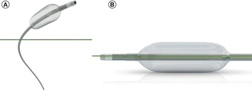 Figure 1. Microballoon catheter.The figure shows an entire inflated microballoon catheter (A) and the inflated balloon (B).Reproduced with permission from Terumo Europe NV, Leuven, Belgium.