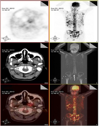 Figure 2 PET/CT (September 2, 2013) displaying relatively favorable tumor burden with bevacizumab combined with the agents already being administered.