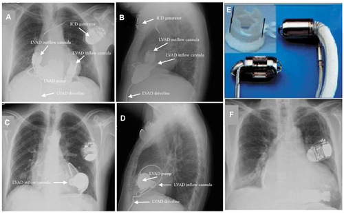 Figure 1 Postoperative chest X-ray illustrating a HeartMate II LVAD and an HVAD.