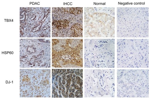 Figure 1 Representative images of the high expression of TBX4, HSP60, and DJ-1 in IHCC and PDAC tumors, and low or negative expression of them in the normal liver tissues (containing intrahepatic duct) and negative controls (IHCC tumors).