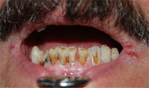 Figure 4 Cheilitis and cracked lips, and teeth cervical caries in a radiotherapeutic patient.