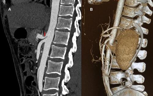 Figure 2 (A) Computed tomography angiography, sagittal view of aorta and celiac artery (CA) in a patient with MALS; redline points at the CA artery stenosis caused by the median arcuate ligament. (B) Three-dimension reconstruction of the CA stenosis due to external compression. Arrow points at the CA stenosis and the post stenotic dilatation.