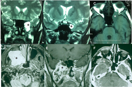 Figure 2 Surgical approaches in trigeminal schwannomas: EEA and facial translocation approach. (A) T2-weighted MRI of a Type ME1 TS. The tumor is in contact with the transition between ethmoidal cells and the sphenoid sinus (*). (B) Tumor into the Meckel’s cave (*). (C) Orbital progression in a T1-weighted MRI (*). This tumor was excised through an EEA. (D) T1-weighted MRI with contrast of an extensive dumbbell-shaped tumor (*) Type ME2 involving the middle and infratemporal fossae as well as the maxillary sinus. (E) T1-weighted MRI with contrast of a TS with a similar pattern of extension (*). (F) Postoperative CT scan of the anterior case showing the removal of the tumor. The operative cavity was obliterated with a temporalis muscle flap (*).