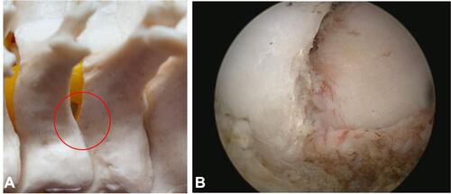 Figure 2 The V-point identification. (A) V-shaped medial border of facet joint (red circle). (B) The endoscopic view of V-point.