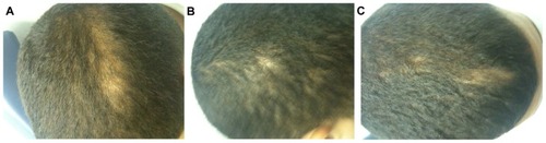 Figure 4 (A–C). Worsening of alopecia seen in three different areas on the scalp at follow-up approximately 1 year after initial visit.
