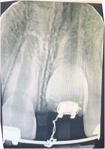 Figure 6. Appointment 3 periapical radiograph showing uncomplicated fracture on teeth Nos. 8 and 9, external inflammatory root resorption, widened PDL spaces, open apices, ragged moth-eaten mesial and distal aspects of the roots. Tooth No. 9 bracket engaged to main arch wire with ligature tie.