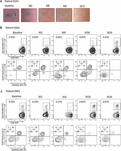 Figure 3. Clinical and immunological responses in patients treated with GeniusVac-Mel4