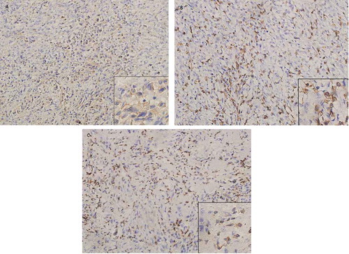 Figure 1. Sample immunohistochemical images.Immunohistochemical staining of PD-L1, CD3 and CD8 on paraffin-embedded slides of resected lumbar metastases tissue. (a) Immunohistochemical staining for PD-L1 in tumor specimens (x200), (b) Immunohistochemical staining for CD8+ TILs (x200), (c) Immunohistochemical staining for CD3+ TILs (x200).
