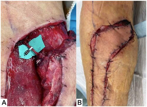 Figure 7. Clinical course throughout the 10 d after flap elevation. (A) The superficial sural vein was clamped with a vascular clip. (B) The flap did not become congested, even after 6 h.