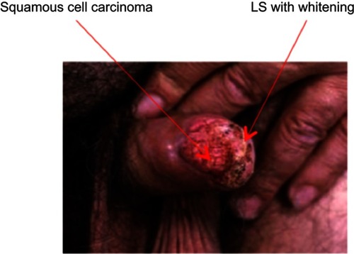 Figure 6 Penile squamous cell carcinoma associated with lichen sclerosus.