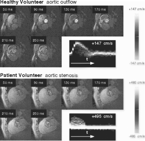 Figure 2. In vivo results from (top) a healthy vounteer and (bottom) an AS patient. Peak velocities, and time-velocity histograms were in agreement with echo studies.