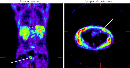 Figure 3. Imaging with PET acetate of local recurrence and lymph node metastases.