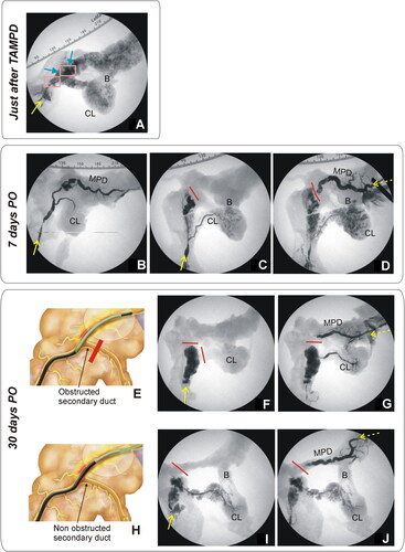 Figure 7. Animal model results. (A) Fluoroscopic image obtained during of the duct permeability test in 0-day Group. Iodinated contrast was injected through the MPD in anterograde, i.e. through papilla (yellow solid line), showing extravasation of the MPD in all cases (blue arrows), including the connecting lobe (CL). (B–D) Fluoroscopic images obtained in 7-day Group. While some animals showed MPD maintained patency when contrast was injected in an anterograde manner via the papilla (yellow solid line), i.e. the contrast occupied almost the entire length of the main duct and part of the connecting lobe (CL) (B), in other animals, the MPD was totally obstructed (red line) and the contrast was thus redirected toward the connecting lobe (C). In these animals, obstruction was confirmed when contrast was injected in a retrograde manner (yellow dashed line), i.e. from the most distal part of MPD (pancreas tail) (D). (F,G,I,J) Fluoroscopic images in 30-day Group. Although complete occlusion of the MPD was observed in all animals (red line represents the duct interruption), the injected contrast course revealed the relative position of the thermal ablation zone with respect to the bifurcation of the connecting lobe (secondary duct). (E–G) In some animals (e.g., 30d-5) anterograde (yellow solid line) and retrograde (yellow dashed line) injections of contrast suggested that the proximal limit of the thermal ablation zone was possibly before the bifurcation (as illustrated in (E)). (H–J) In other animals (e.g., 30d-4) anterograde and retrograde injections suggested that the proximal limit of the thermal ablation zone was possibly posterior to the bifurcation (as illustrated in (H)).