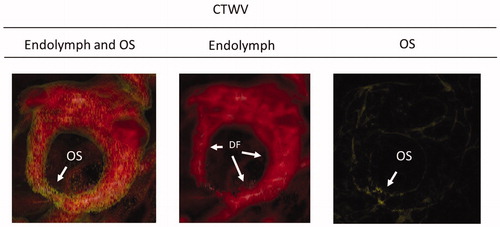 Figure 7. Representative cases of healthy subjects without dizziness despite existing canalolithiasis. Small amount OS are recognized in the HC with two CTWVSs of endolymph (red color) and OS (yellow color), but its amount indicates level +1 with CTWV of OS (yellow color). CTWV: CT window value; DF: driving force; HC: horizontal canal; OS: otoconia-like substance; (cf. Figure 4(A)): no dizzy patient with totally occluded cupulolithiasis.