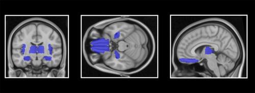 Figure 1 Demonstration of anatomically defined regions of interest (ROIs): insula cortex, hippocampus, frontal superior orbitofrontal cortex/rectus gyrus and thalamus.