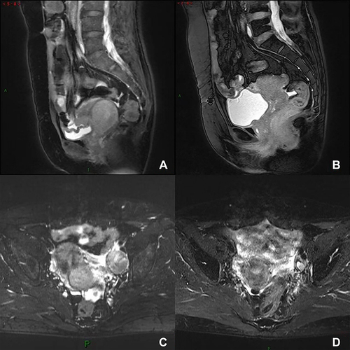 Figure 1 MRI scans. (A) and (C) show the cervical lesion and the left pelvic wall metastatic lymph node before treatment, respectively; (B) and (D) show the cervix and the left pelvic wall lymph node after treatment, respectively.
