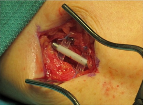 Figure 1 Implant fixed to fascia over the tibial nerve in patient 3.