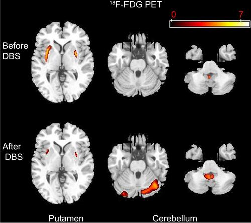 Figure S1 Comparison of 18F-FDG PET imaging before and after deep brain stimulation in patient’s right subthalamic nucleus.Abbreviations: 18F-FDG PET, fluorodeoxyglucose positron emission tomography; DBS, deep brain stimulation.