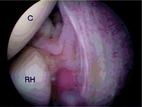 Figure 1. Arthroscopic view of the lateral joint space. The elongation of the lateral ligamentous complex is quite obvious. RH: radial head; C: capitulum.