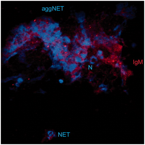 Figure 2. Example of aggNETs. Aggregated NET (aggNET, blue) structures are bound by IgM (red) from patients with dry eye disease. Single NETs (NET, blue) and intact Neutrophil nuclei (N, blue) can be seen.