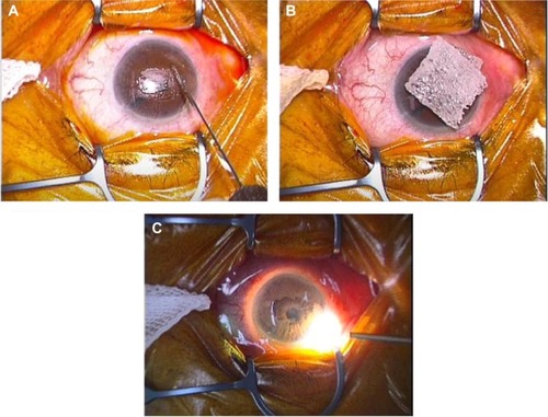 Figure 1 Surgical technique.