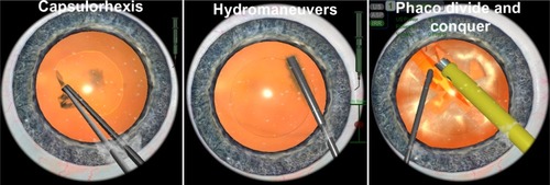 Figure 1 In the capsulorhexis procedure, the trainee has to inject viscoelastics into the anterior chamber, create a flap with a cystotome in the anterior capsule, and finally complete a circular capsulorhexis. In the hydromaneuvers module, the trainee places a cannula under the rhexis edge and injects liquid solution at the right speed, creating a visible fluid wave in the cortex. Afterwards, the trainee rotates the nucleus, proving that an appropriate hydrodissection has occurred. During the phacoemulsification (phaco) divide and conquer, the trainee has to create grooves in the nucleus, crack the nucleus into quadrants, and finally consume the quadrants with ultrasonic energy using phacoemulsification.