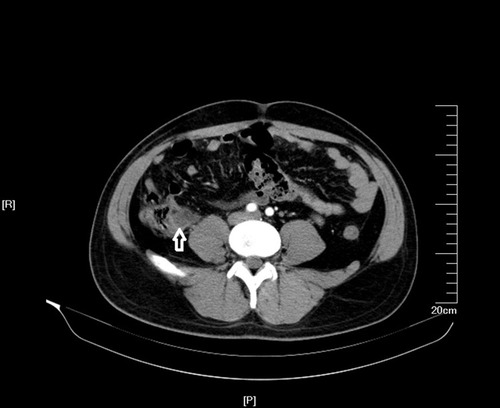 Figure 1 Abdominal contrast enhancement CT scan shows an abscess lesion of ileocecus (white arrow).