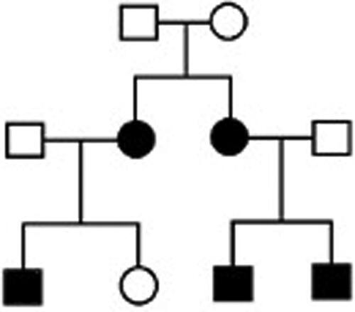Figure 4. A family with LHON with five affected individuals (four of them previously reported [Citation24]) with the G3635A, p. S110N mutation in MT-ND1.