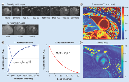 Figure 4.  T1- and T2-mapping are quantitative cardiac MRI biomarkers that reflect changes in myocardial microstructure. (A) A series of cardiac images are acquired at different times after an ‘inversion pulse’ that manipulates the longitudinal magnetization and the corresponding image contrast. Alternately, in (B) a series of images are acquired after different durations of ‘T2 preparation’ that manipulates the transverse magnetization and the corresponding image contrast. (B) Curve fitting is performed on a pixel-wise or region of interest basis (white boxes) and used to estimate the local tissue’s T1 and T2. The signal intensities (dots) represent the relative magnitude of the magnetization used to produce each of the images. Solid curves represent the curve fit for the equation in each plot. Additionally, the T1 plot shows the dashed curve with the first few data points not inverted about the ‘null-point’ – where signal from myocardium is suppressed (∼700 ms). After curve fitting (C) T1- and (D) T2-maps are generated on a pixel-wise basis.